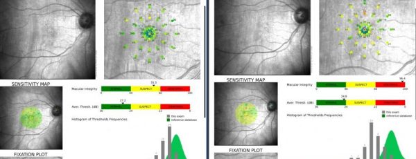 En la imagen de la derecha observamos la MICROPERIMETRÍA antes del tratamiento, en la de la izquierda, 3 meses después, mejora la sensibilidad media retiniana y el histograma (abajo a la derecha de ambas imágenes).