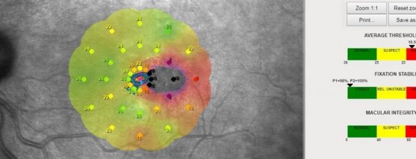 En la imagen observamos a la derecha del punto de fijación unos puntos negros (Sensibilidad retiniana= 0 decibelios) correspondientes a la zona de la retina donde el paciente no ve nada, lo que conocemos como escotoma absoluto.