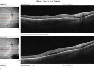 El paciente acude a visita sin el cuadro resuelto y se decide cambiar el tratamiento por Laser 2RT. En la imagen inferior pueden ver antes del tratamiento y en la superior una semana después del tratamiento donde se aprecia la retina seca.